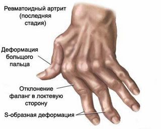 rankų išsipučia priežastis ir skausmas rankų sąnarius ko truksta kai skauda raumenis