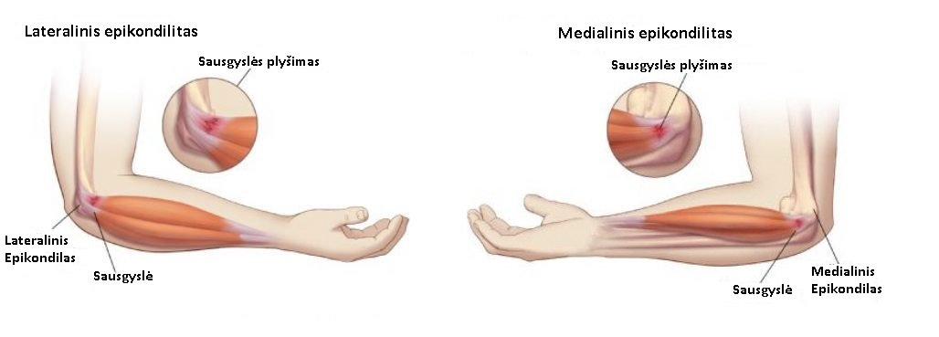 rankų raumenų skausmas ray gydymas sąnarių