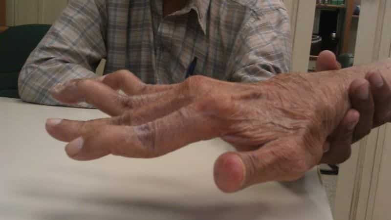 reumatoidinio artrito faktorius spondylosis artrozė gydymas