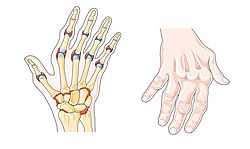 reumatoidinis artritas liga alkūnės sąnario pusės