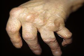 reumatoidinis artritas šepečių rankos standartinė už artrozės peties sąnario gydymo