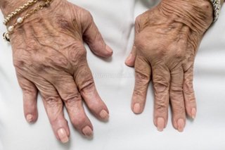 reumatoidinis artritas liaudies medicina