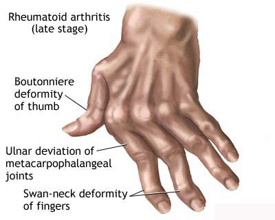 reumatoidinis artritas pečių dažymo artrozės gydymas