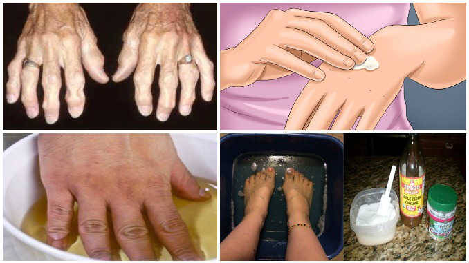 tradicinių gydymo metodai artrozės ir artrito kas balzamai sąnarių