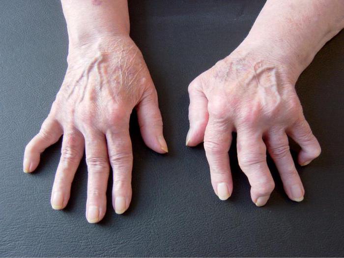 artritas ir artrozė brush rankų ir jo gydymas