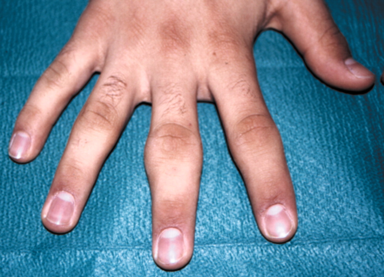 swollen painful knuckle joints
