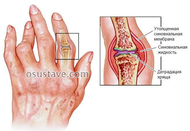 artritas pirštai šepetys skausmas krutines lastoje