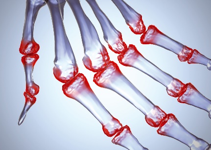 gydymas artrozės nuo pirštų rankų sąnarių liaudies gynimo priemones liaudies medicinoje ligų sąnarių