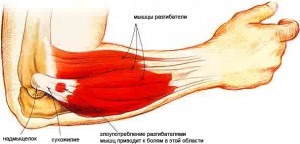 artrozė dilbio sąnarį