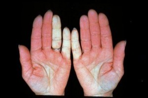 rankiniai pirštai ir ligos grietinėlės arba tepalas nuo sąnarių skausmo atsiliepimus