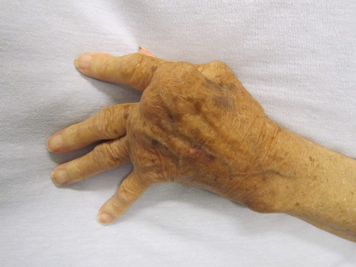 artritas vikipedija prevencija ir gydymas sąnarių uždegimu