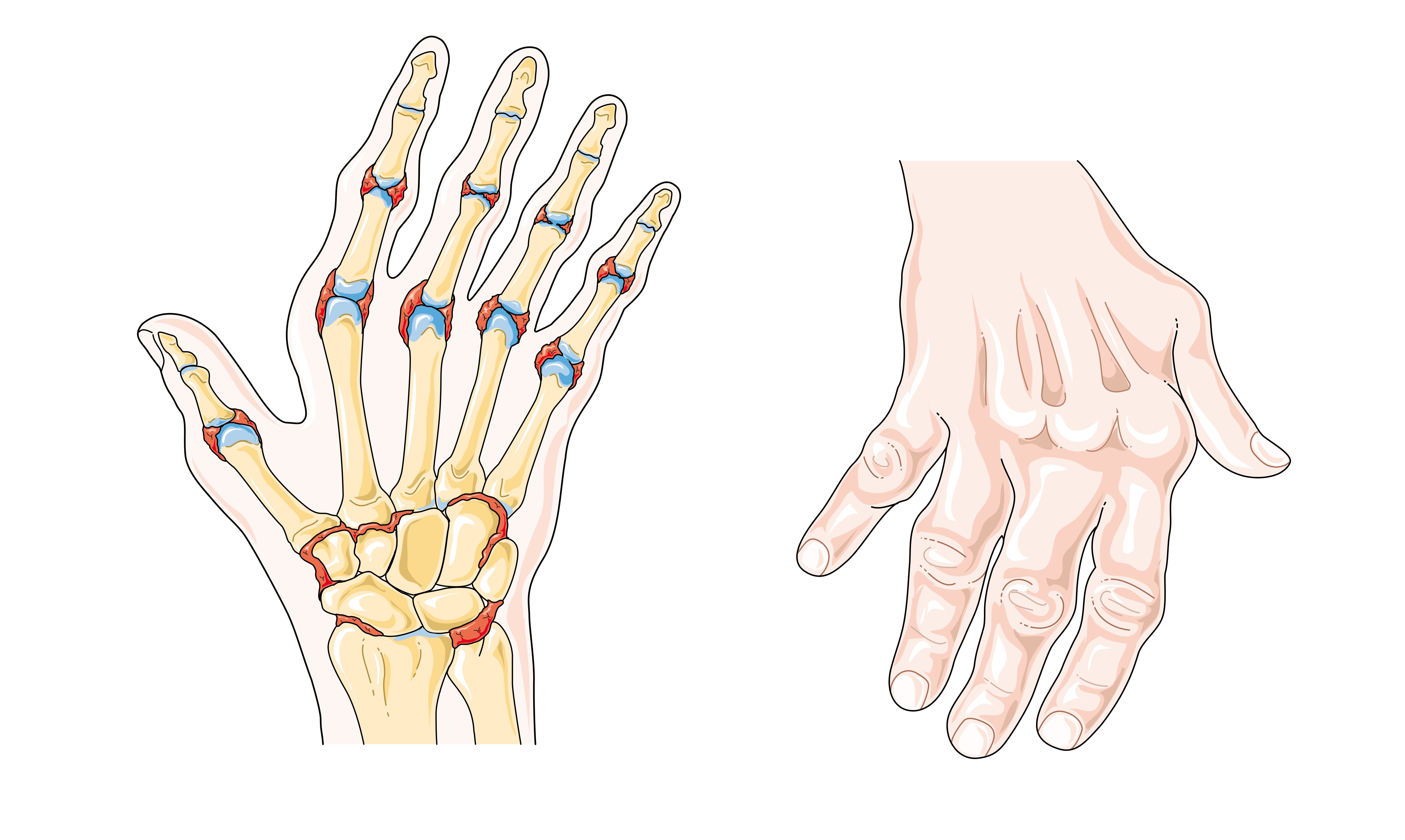 reumatoidinis artritas skausmas peties sąnario sustingimo pirštų