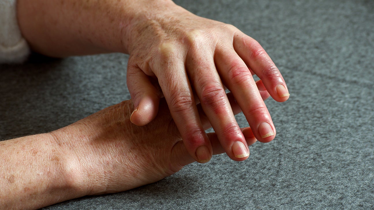 skausmas artritu peties sąnario gydymas kurpelė sąnarių
