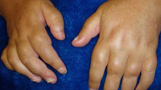 swollen hands painful joints pregnancy