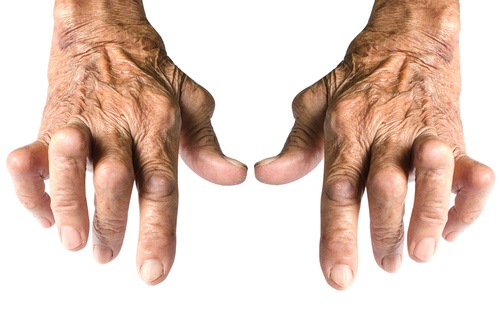 reumatoidinis artritas forumas