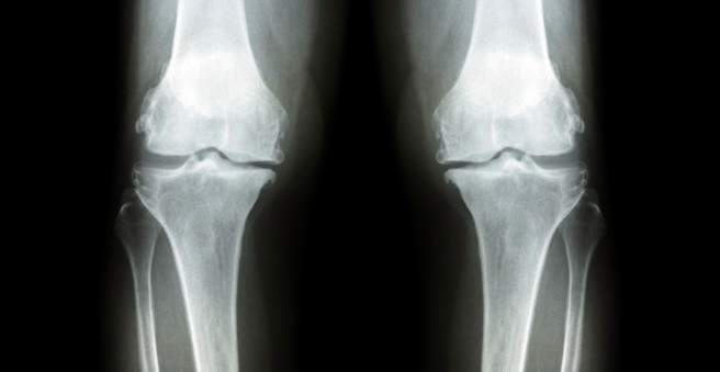 artrozė osteoartrito gydymui