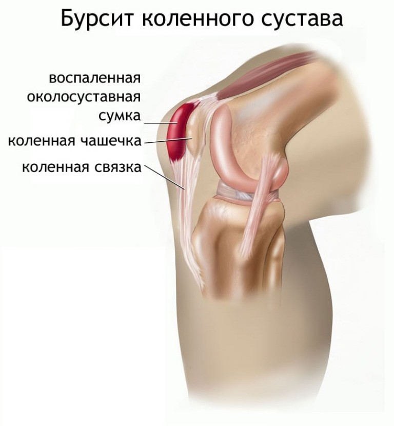 osteochondrozė kojos laikykite pirštų artrito sąnarius