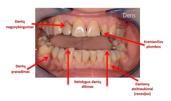 skauda sąnarį dantenų osteochondrozė sąnarių gydymas