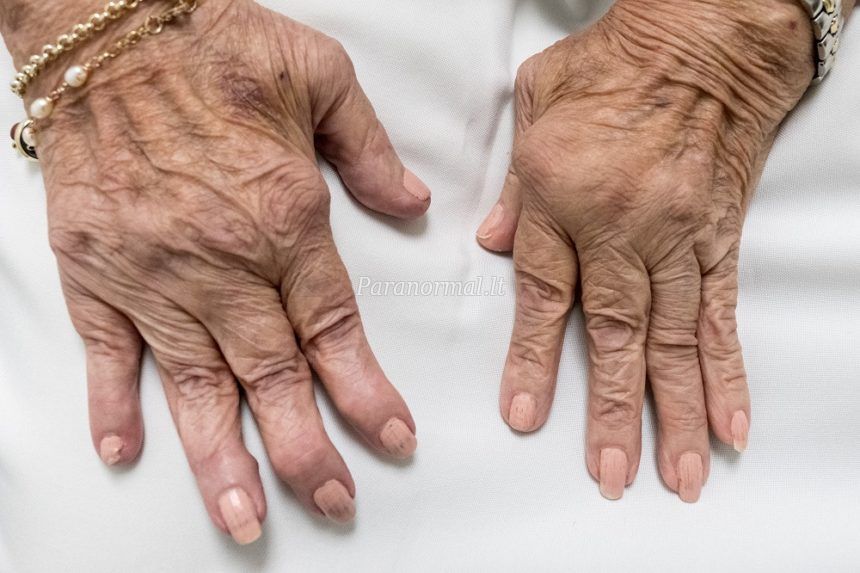artritas vikipedija ne šyla tepalai sąnarių