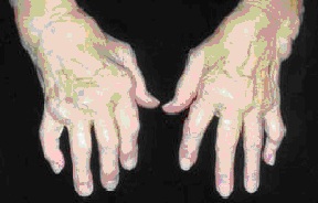 kaip atsikratyti artrito rankas kas tepalai ir geliai osteochondrozės metu