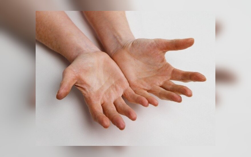 artritas rankos gydymas namuose