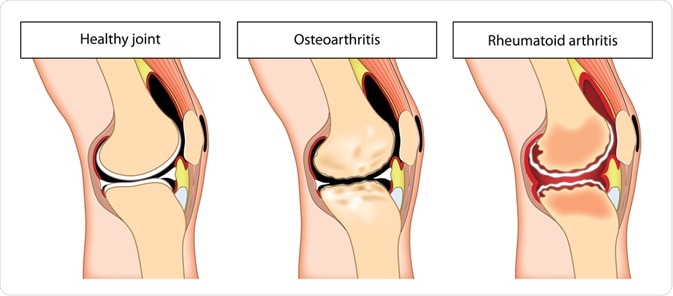 nacionalinės gydymo metodai artrozės osteochondrozė iš tepalas atgal