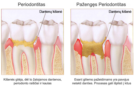 skauda sąnarį dantenų kokie augalai pagalba skausmai sąnariuose