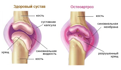 osteochondrozė skausmas