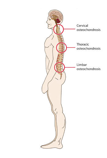 dip relief ne osteochondrozės pradėjo artrozė iš peties sąnario