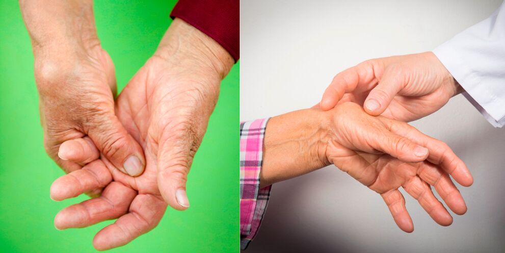 pelargonija įrankis reumatoidinis artritas biologiniai vaistai