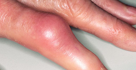 artritas podagra pirštai