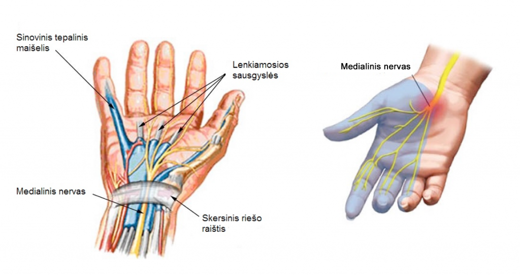 įrankiai iš sąnarių skausmas vaistinėje skauda daug mergautinė naštą ant savo kairės rankos