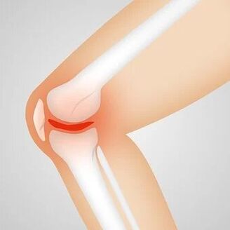 artritas artrozė nykščio dislokacija tempimo sąnarių gydymo