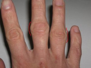 artritas prasideda pirštais krapų gydymas sąnarių