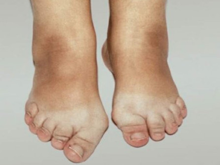 liaudies gynimo priemonės skirtos artrozės pėdos gydymo gerklės sąnariai ir raumenys