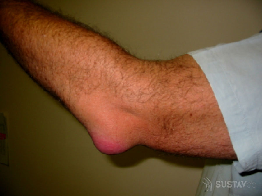 liga yra artritas sąnarių skausmas peties sąnario priešais