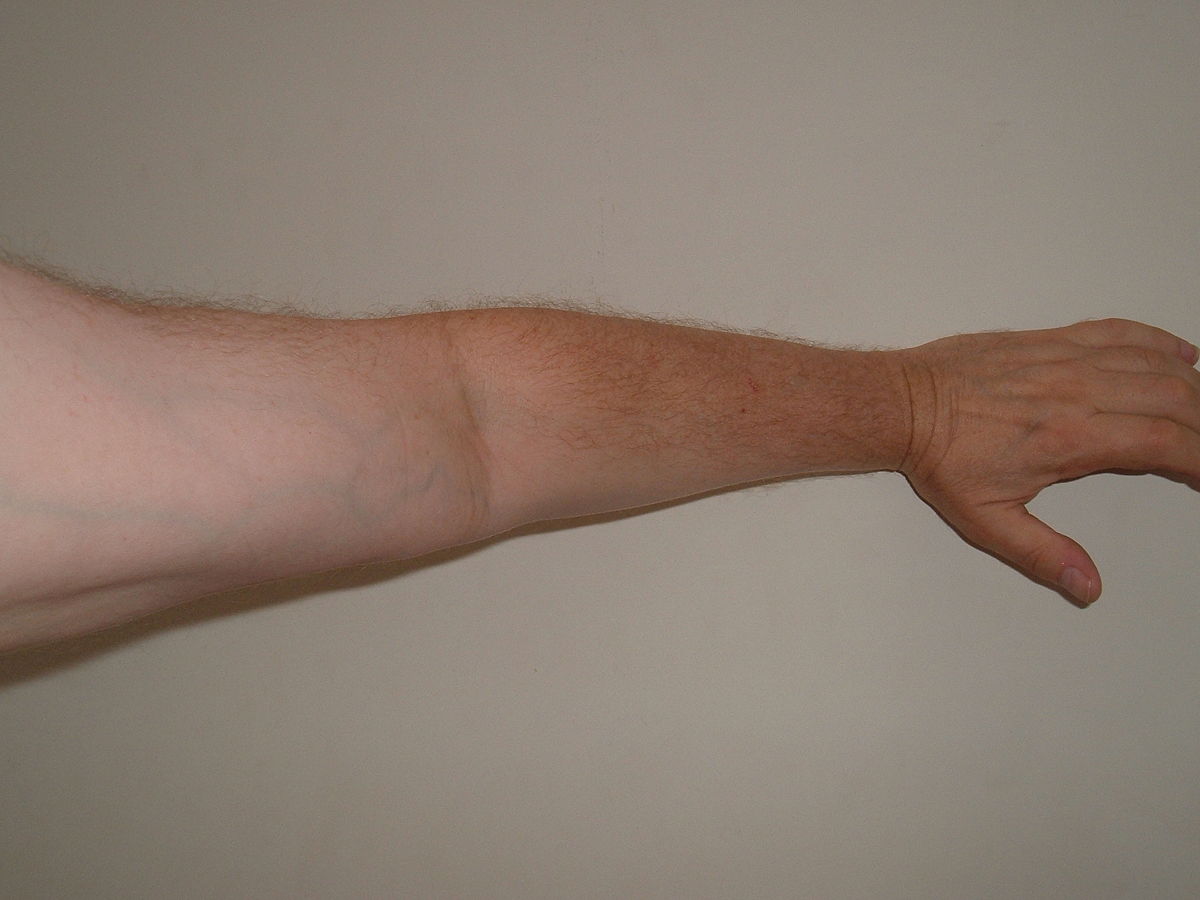 gerklės knuckles alkūnes rankas mmilano artrozė gydymas