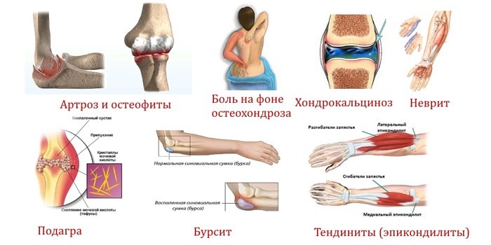 artritas šepetys pirštas 1 podagrinio artrito sustava