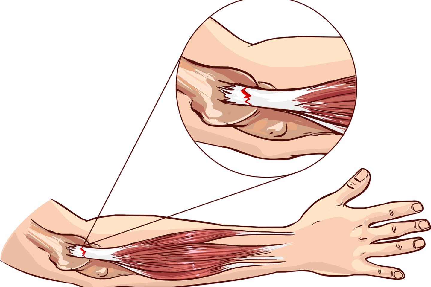 skauda sąnarį ant viduriniojo piršto iš kairės rankos nei skausmui malšinti raumenų ir sąnarių