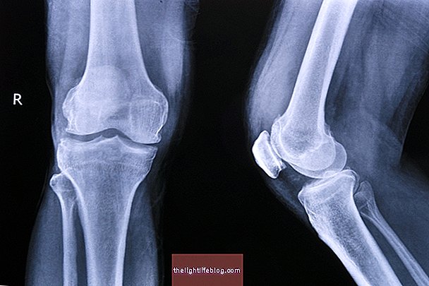 gydymas artrozė kojų tabletės kas yra artrozė amerikoje