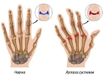 gydymas artrozės ir rankas rankas liaudies gynimo skausmas kulno ir sąnarių