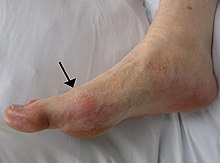 kaip sustiprinti alkūnės sąnarį po traumos gydymas artrozė kojų atsiliepimus