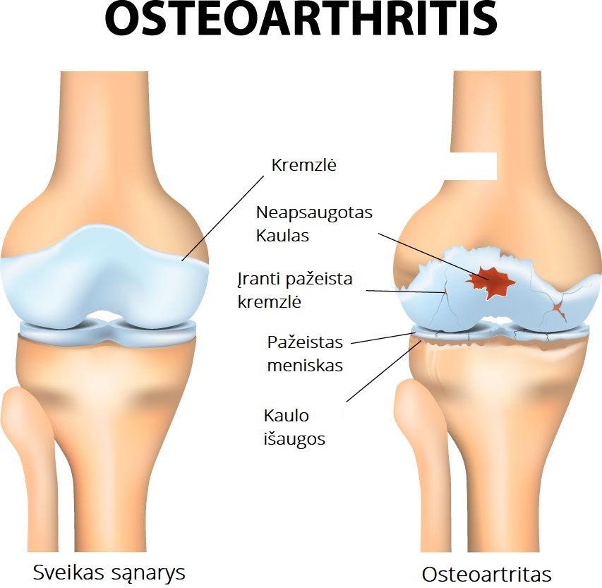 raumenys ir sąnariai skauda reumatoidinis artritas snukio sąnarių