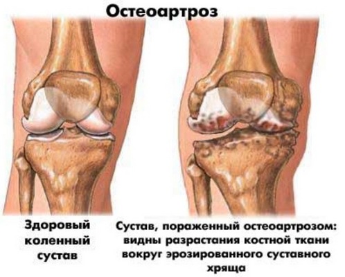 kas yra gydomi artritas pėdų i hit pirštu sąnarių skausmas